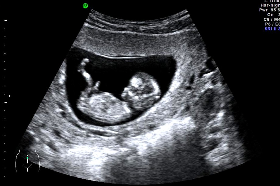ultrasound dating scan