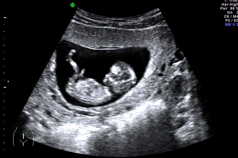 dating pregnancy ultrasound